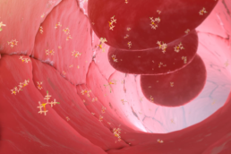 Stem cell transplantation for blood-related cancer