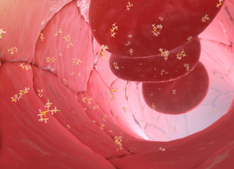 Stem cell transplantation for blood-related cancer