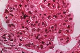 Narsoplimab &ndash; nearing Phase 3 program for treatment of lupus nephritis